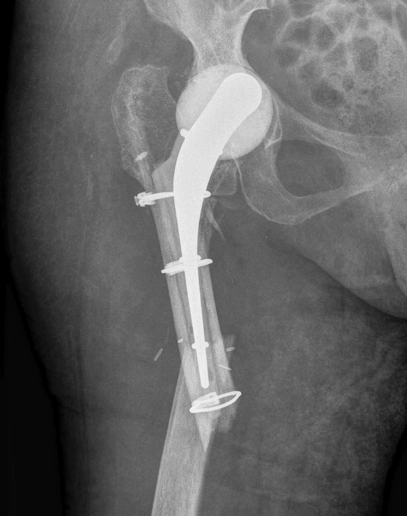 Prostalac Femur Fracture